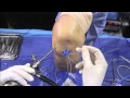 Horizontal Meniscal Tear Repair Using the Knee Scorpion™ Suture Passer