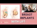 Breast Implants with or without a Lift? How to Decide.