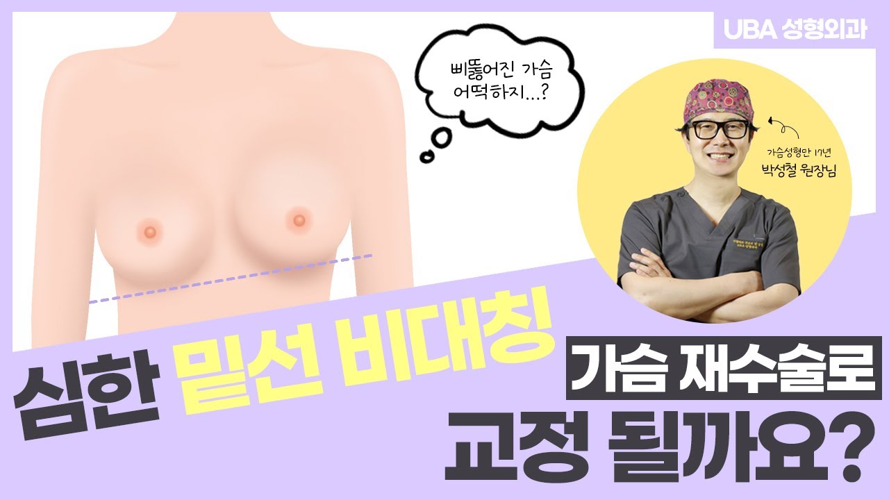 uba성형외과 가슴재수술