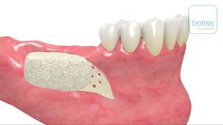 maxgraft® bonebuilder in mandible including incisions by Dr. Dr. O. Blume