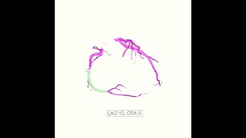 Chronic total occlusion of the right coronary artery