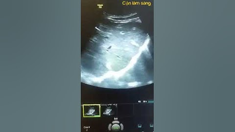Diaphragmatic slips - tạm dịch: Mảnh hoành | Bs. Lê Đăng Hùng
