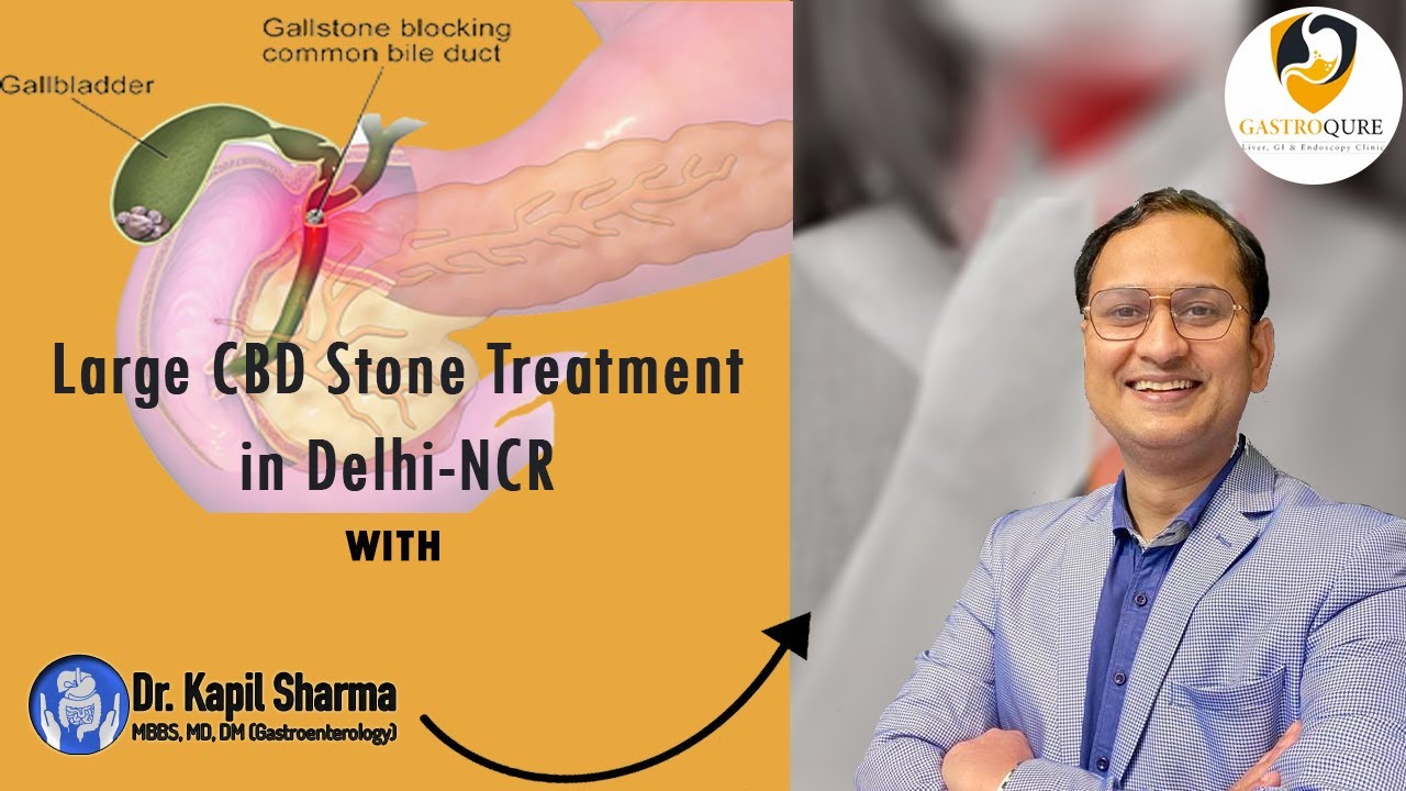 Best CBD Stone Treatment in Delhi-NCR | Laser Lithotripsy Before Surgery | Dr. Kapil Sharma