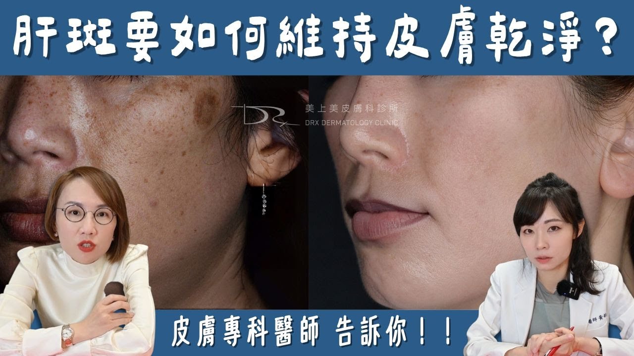 不想肝斑復發！治療好如何穩定色素？「維持療法」公開！讓你不再瓶瓶罐罐！