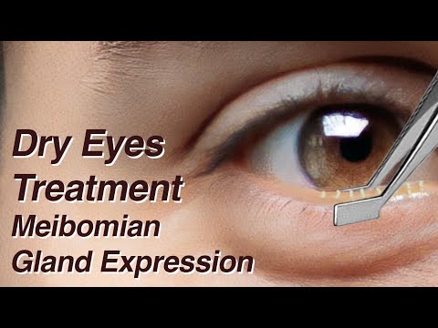Dry Eyes Treatment