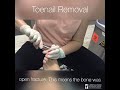 Toenail Removal