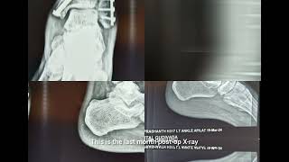 Ankle Fracture in 56 year old ..3months post surgery outcome