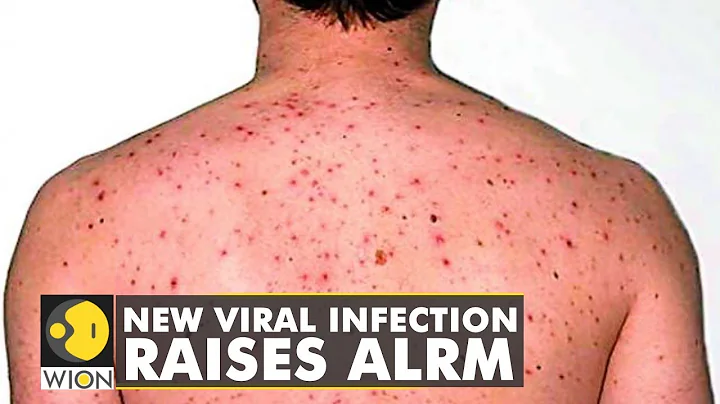 Monkeypox outbreak in Europe, Australia, US; WHO calls an emergency | World News | WION - DayDayNews