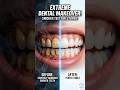 Smoking Effects to Teeth #SmokingEffects #DentalCleaning #ToothRepair #SmokerTeeth #PlaqueRemoval