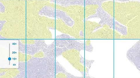 Evaluating the CPS Denominator - A Precision Pathology Training Video from Agilent