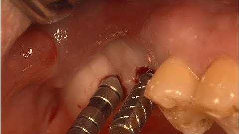 Simple Sinus lifting using Osteotome & Digital Guide