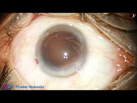 Totally unedited Phaco: Direct Chop and cortical aspiration by hand-piece : P Mohanta, July 27, 2026