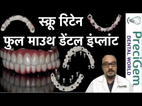 स्क्रू रिटेन डेंटल इंप्लांट l Full mouth dental implants|l all on 6 | All on 4 | Dr Mayur Khairnar