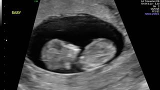 11 Weeks 2 Days Fetal Ultrasound - Baby Jumps!