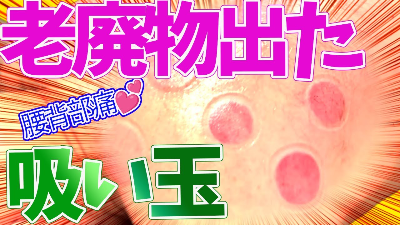 【吸い玉 腰痛 お灸 中野】中野で腰痛でお悩みなら吸い玉とお灸の哲学堂鍼灸院 - YouTube