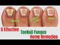 5 Natural Remedies For Toenail Fungus – Toenail Fungus Treatment At Home