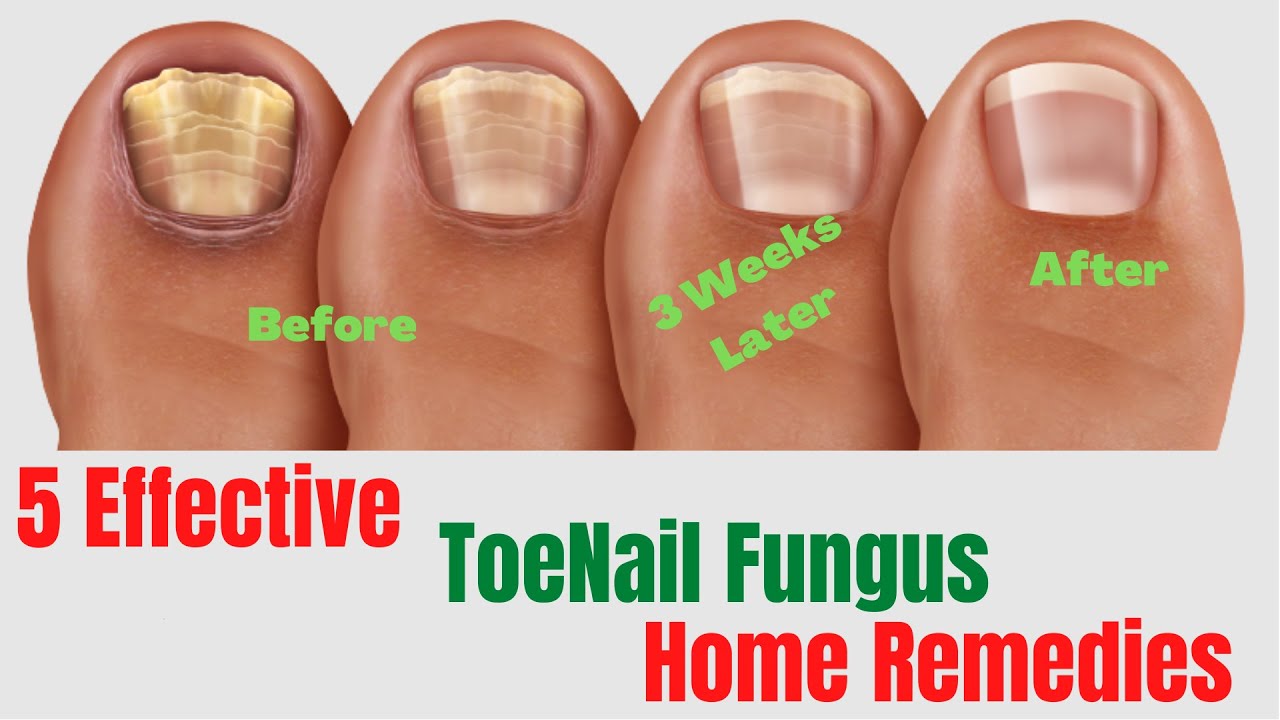 Laser Nail Fungus Therapy At Home | Best Way To Get Rid of Toe Fungus