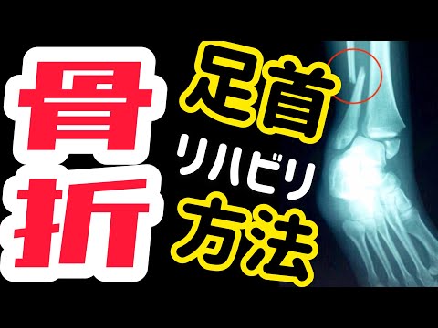 【足首骨折を早く治す方法】足首骨折が治る歩けるまでのリハビリ方法！足首骨折で痛い・歩行がしづらい！そんなあなたにストレッチやリハビリのやり方を公開！