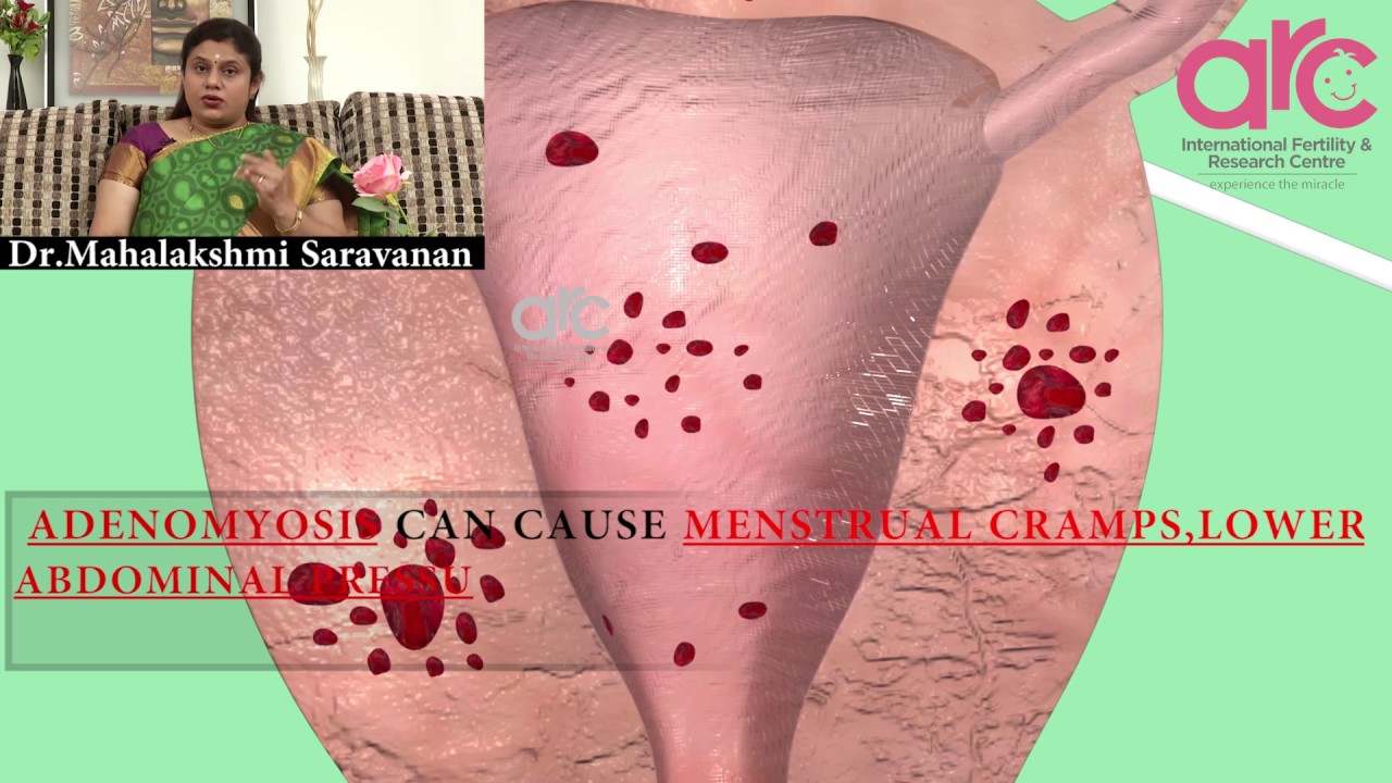 Adenomyosis Uterus Risk Factors Symptoms Diagnosis Signs Treatments Arc Fertility Hospitals Youtube