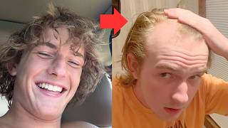 My Entire Balding Journey Age 14 - 20