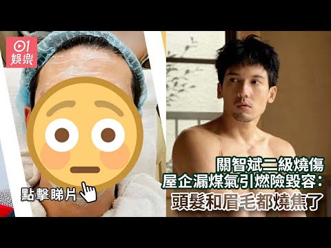 關智斌二級燒傷 屋企漏煤氣引燃險毀容：頭髮和眉毛都燒焦了｜01娛樂｜關智斌｜Kenny｜香港藝人