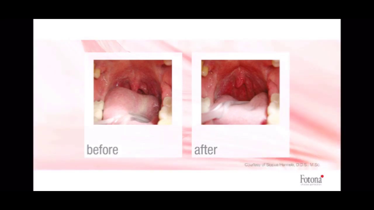 Sleep Apnea Laser Treatment YouTube