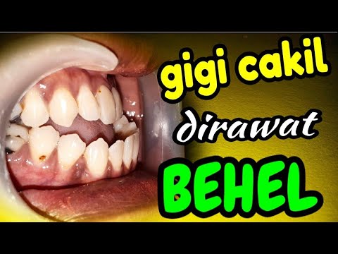 Video: Kapan Kawat Gigi Dipasang Di Rahang Bawah?