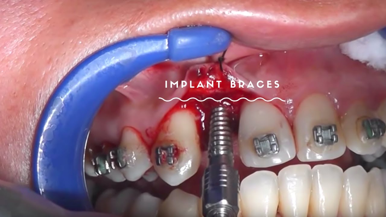 สี ดัด ฟัน สวย ๆ  Update  จัดฟันใส่รากฟันเทียม (Braces and implants)