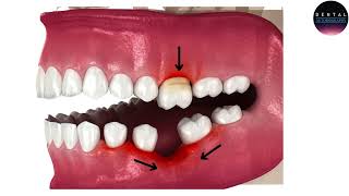 The Consequences of Not Replacing Missing Teeth After Extraction