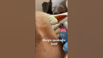 #adcexam #adc #dentalprocedure #dental #pfmcrown