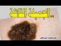 الشامة Nevus الجميلة القاتلة هل هي علامة من علامات الجمال أم الخطر الشامة Nevus الجميلة القاتلة هل هي علامة من علامات الجمال أم الخطر