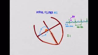 LLSA 2015-01 Supraventricular Tachycardias