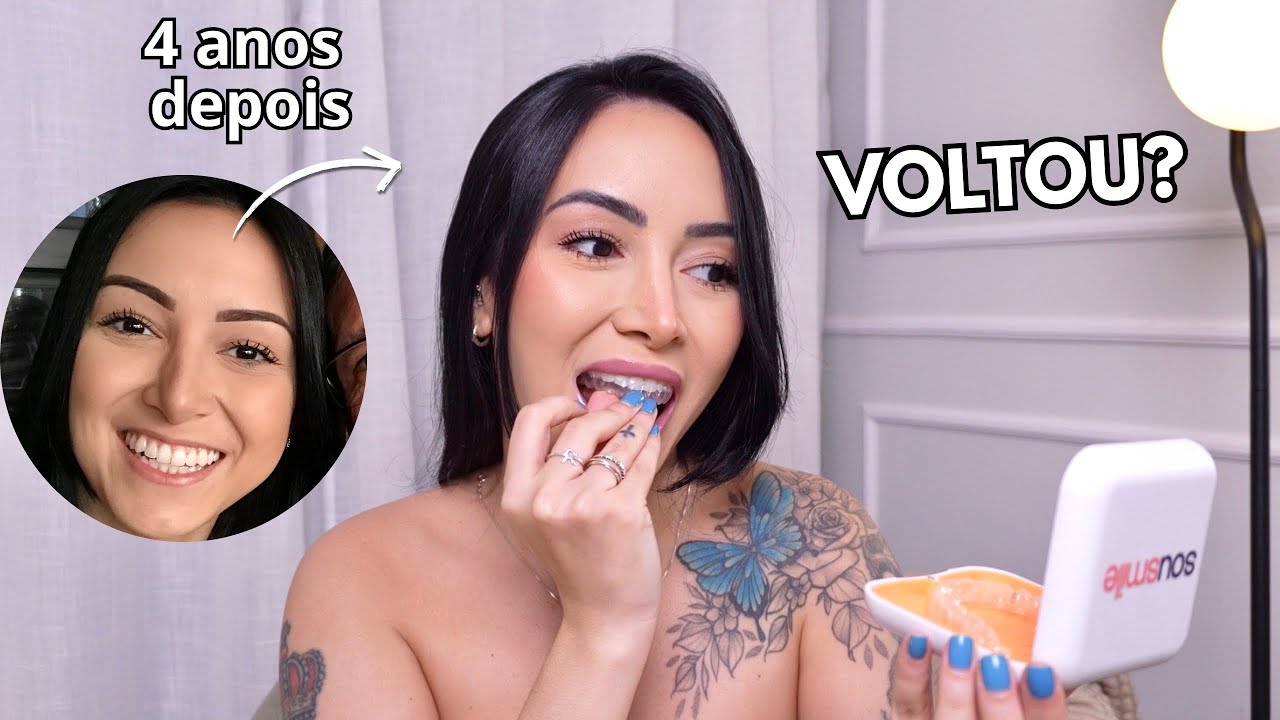 meu sorriso mudou pra sempre? 4 anos depois do tratamento com aparelho invisível