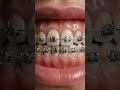 How Braces Are Installed – Step-by-Step 3D Animation