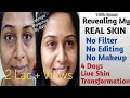 Revealing My REAL Skin Transformation Using Home Remedy | Live Results - No Pigmentation, No D spot