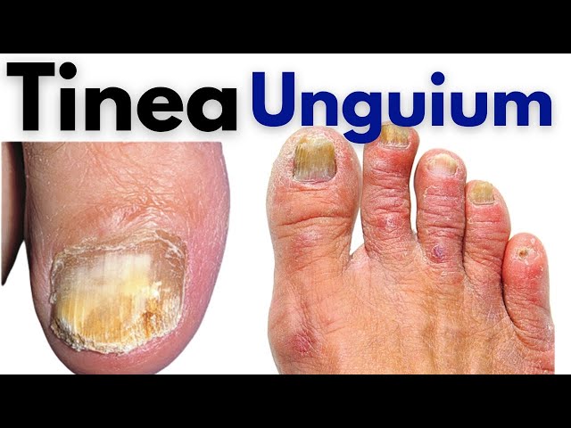 Tinea unguium infection, nail fungus treatment at home