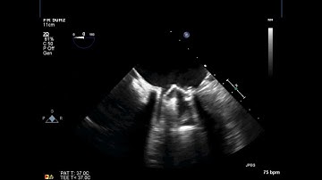 Prosthetic Mitral Valve Obstruction - TEE