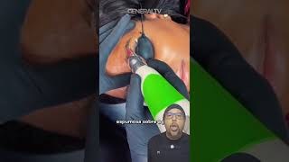 ADEUS TATUAGEM DO EX: adesivo PFD faz laser apagar 4x mais rápido #short