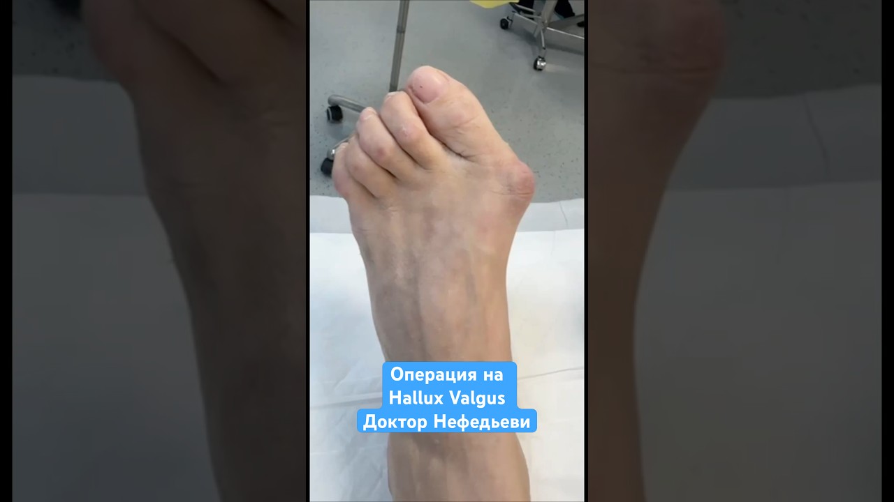 Деформация переднего отдела 🦶🏻обеих стоп🦶🏻