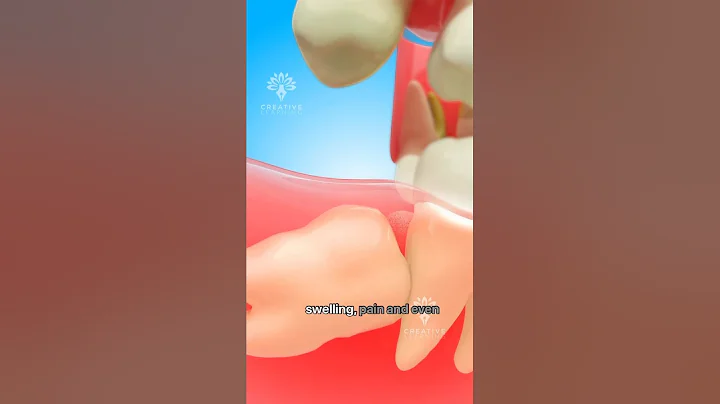 Impacted Wisdom Tooth Removal – What Really Happens 🦷 #short  Creativelearning3d