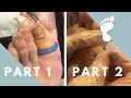 TOENAIL + INCLUSION CYST REMOVED | IMMEDIATE RELIEF!!!