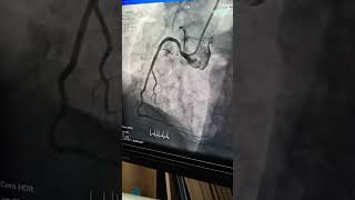 Normal Right Coronary Artery Rca