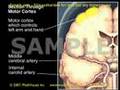 Transient ischemic attack and stroke medical animation