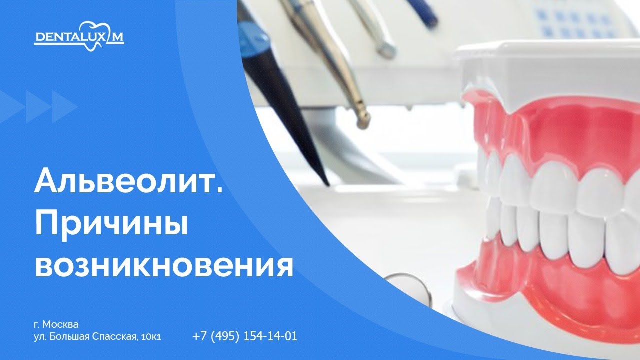 Альвеолит мкб. Постэкстракционный луночковый альвеолит. Альвеолит после удаления зуба мудрости.