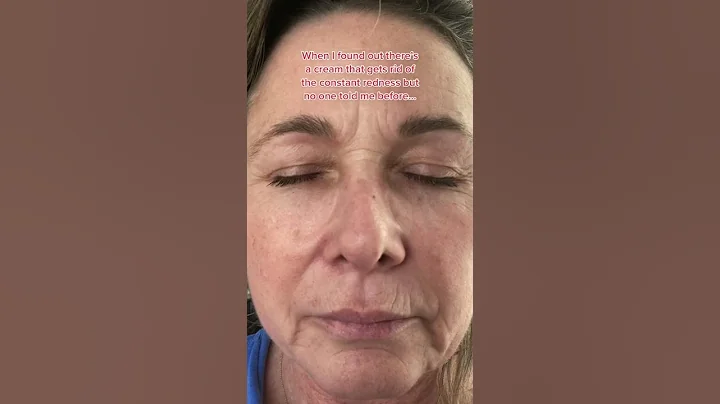 Rosacea Treatments to the rescue | Musely FaceRx #shorts