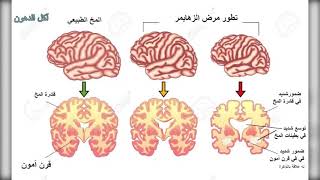 مرض الزهيمر و الدهون و إرتفاع الإنسولين... مرض السكر النوع الثالث