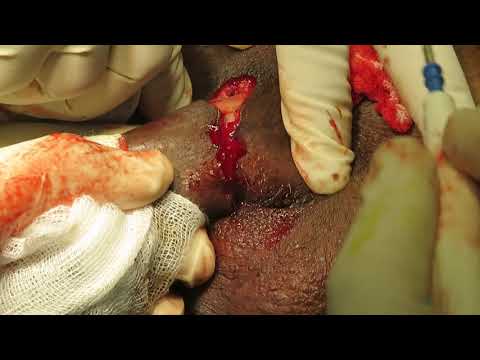 Total penectomy with perineal urethrostomy