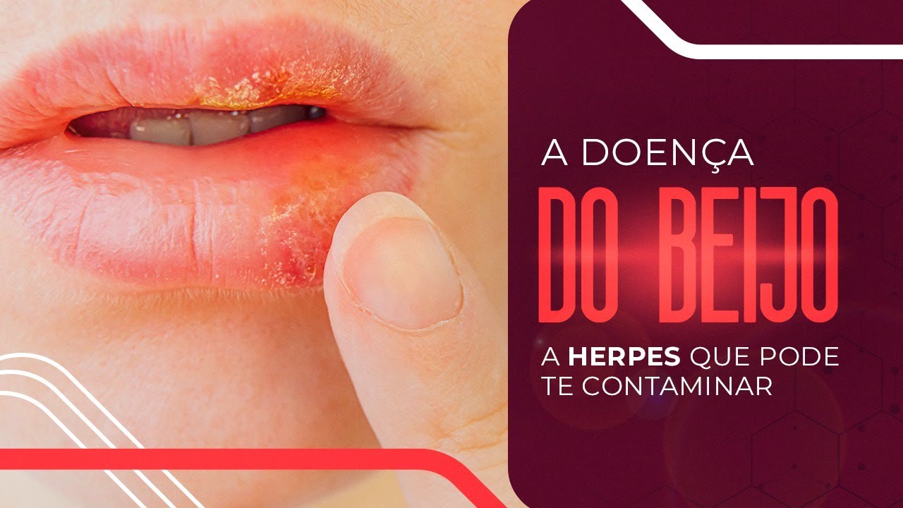 A DOENÇA DO BEIJO: Como se trata e como prevenir a Mononucleose? - YouTube