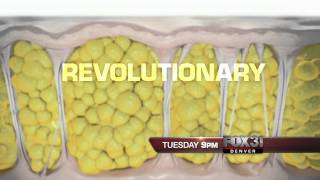 Tuesday on FOX31 Denver News at 9PM: A "Cure" for Cellulite?