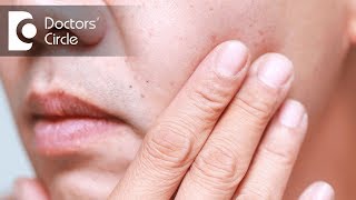 What causes red dots on face and its management? - Dr. Nischal K